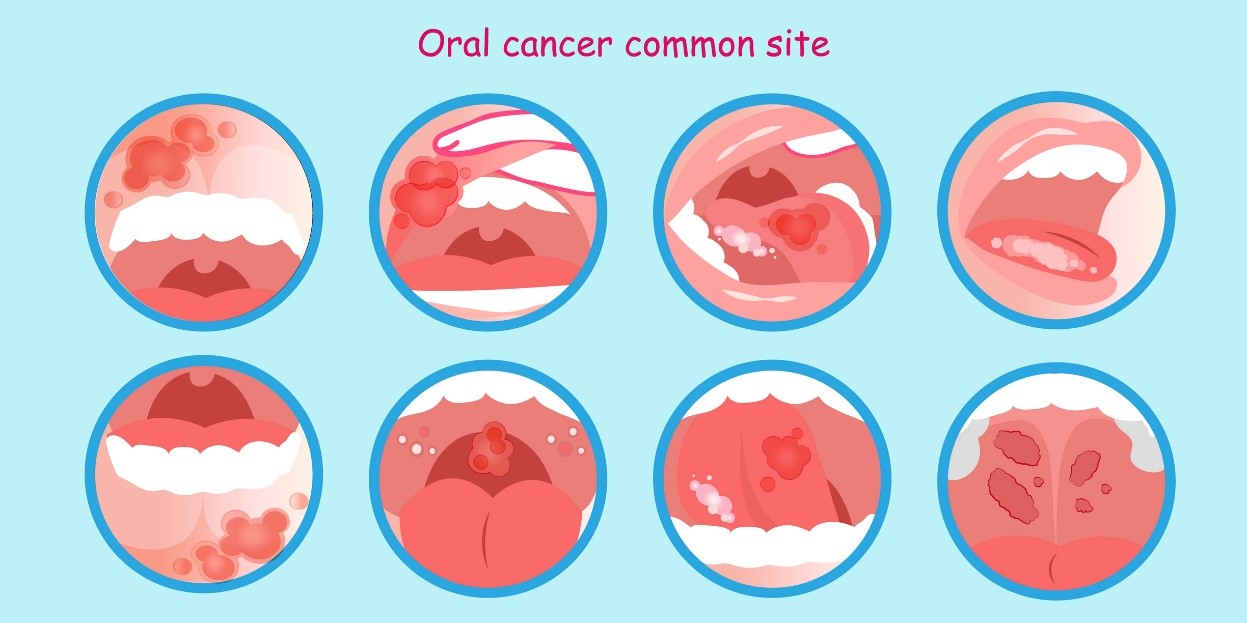 Mundkrebs und Tumorablagerungen - ein Modell