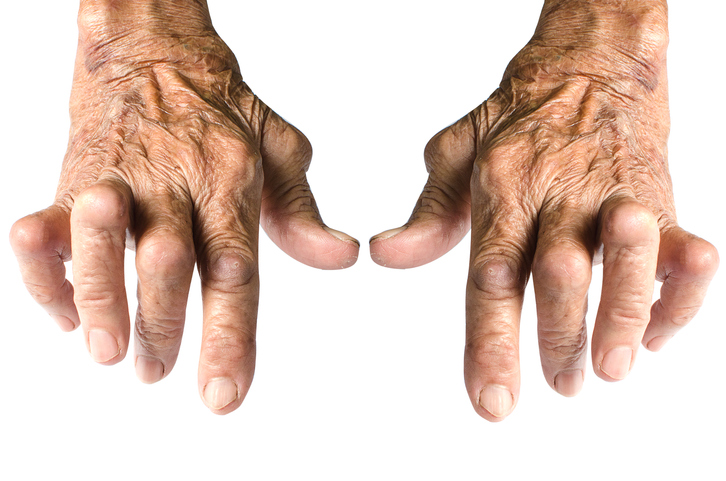 Typische Handdeformitäten bei rheumatoider Arthritis