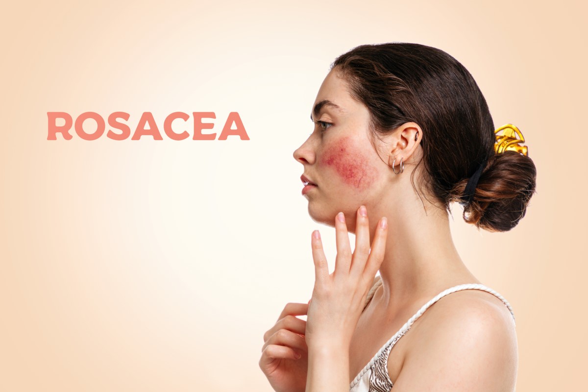 Frau von der Seite, Gesicht mit Rosacea - Rosacea