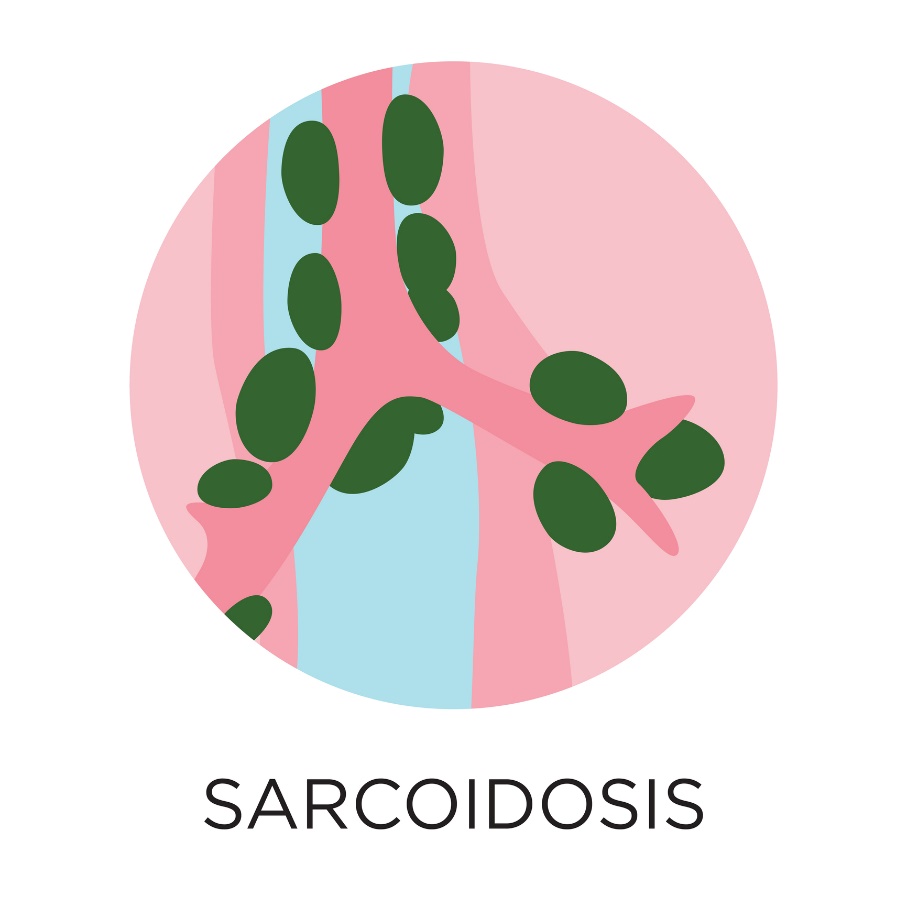 Sarkoidose - Bildung von Granulomen