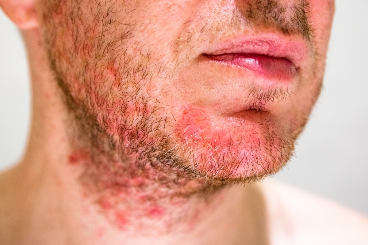 Mann mit Seborrhoe am Kinn, rotes Gesicht mit Anzeichen von Dermatitis