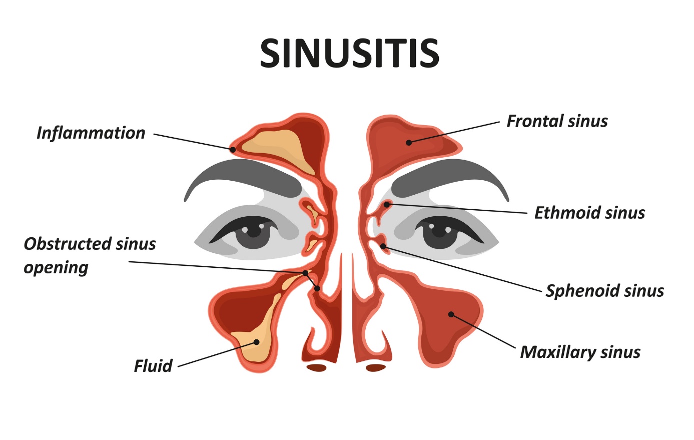 Animiertes Modell/Bild der Sinusitis und der Nasennebenhöhlenentzündung