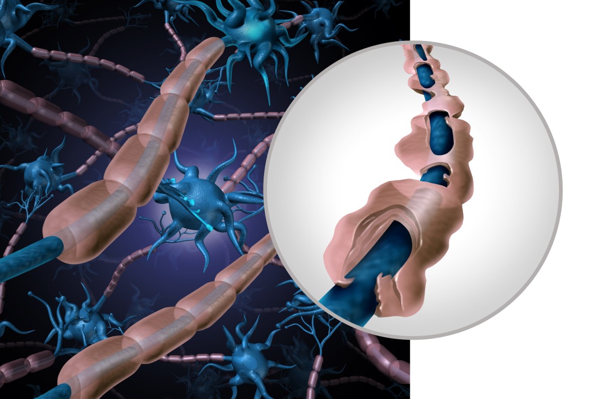 Anatomische, bildliche Darstellung eines gesunden und eines geschädigten Neurons - demyelinisierte Faser