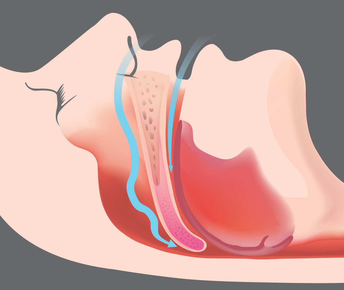 Obstruktiver Atemstillstand und Atemwegsobstruktion - animiertes Bild und Atemwegsmodell