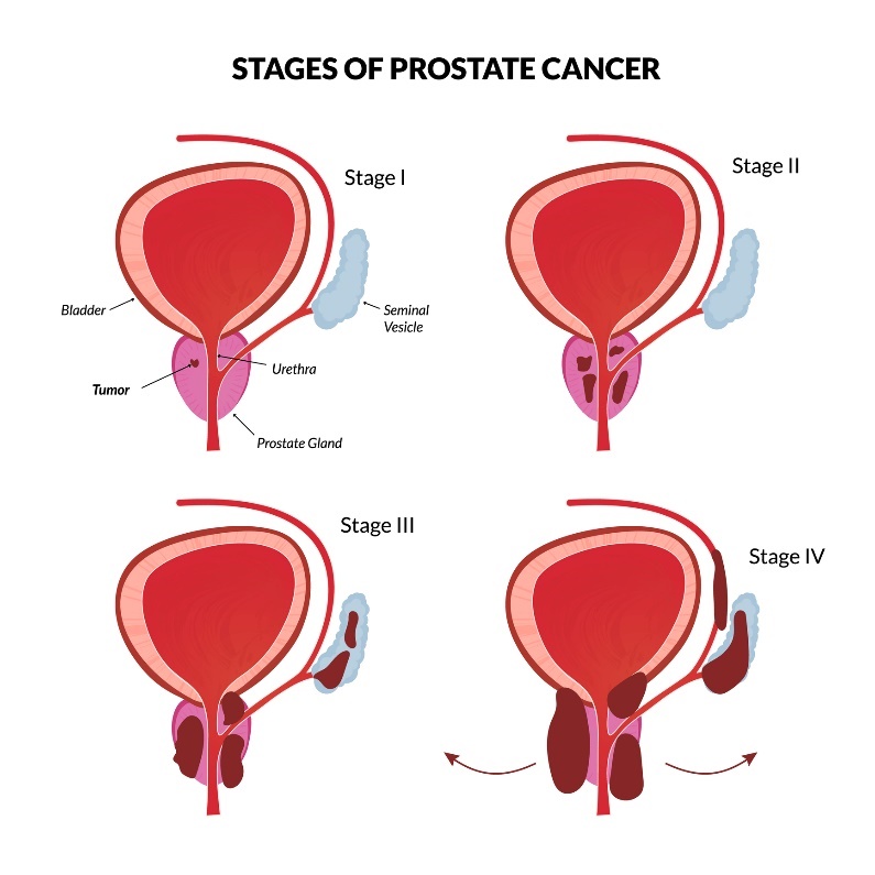 4 grundlegende Stadien von Prostatakrebs