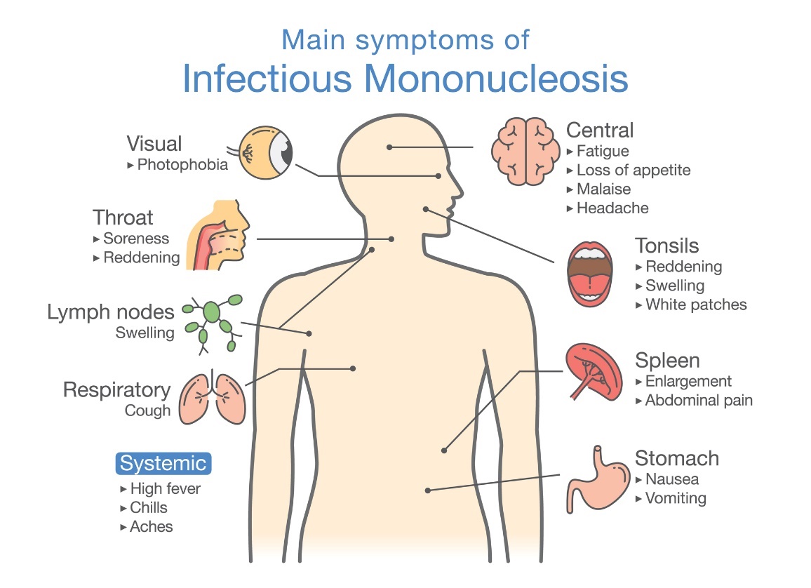 Symptome der infektiösen Mononukleose