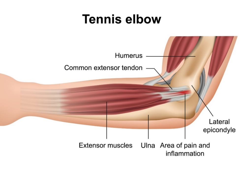 Tennisarm (Epicondylitis lateralis): die Knochen des Ellenbogengelenks, die muskulären Streckmuskeln des Unterarms, der laterale Epicondylus und der Ort des primären Schmerzes.