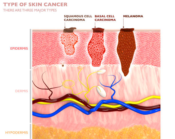 Arten von Hauttumoren, ihr Eindringen in die Haut - Plattenepithelkarzinom, Basaliom und Melanom