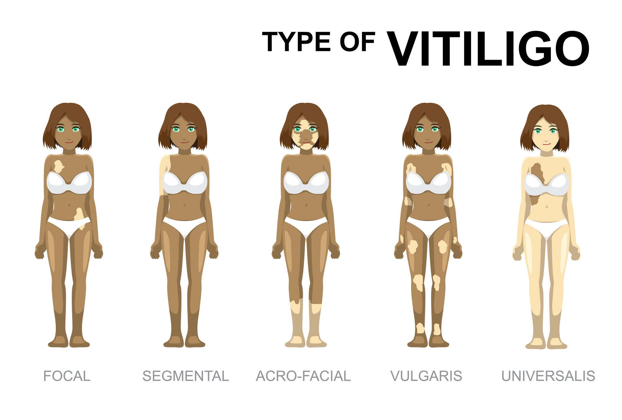 Arten von Vitiligo