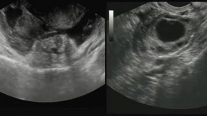 USG - Sonographie des Unterleibs - Bild während der Untersuchung, Darstellung der Gebärmutter und der Eileiterschwangerschaft