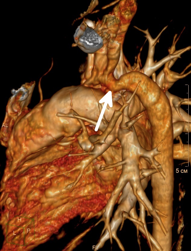 Darstellung einer Coarctation (Verengung) der Aorta im absteigenden Teil des Herzgefäßes.