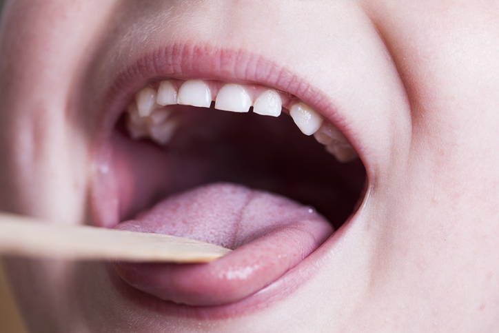 Untersuchung des Rachens mit einem hölzernen Zungenspatel - Kind