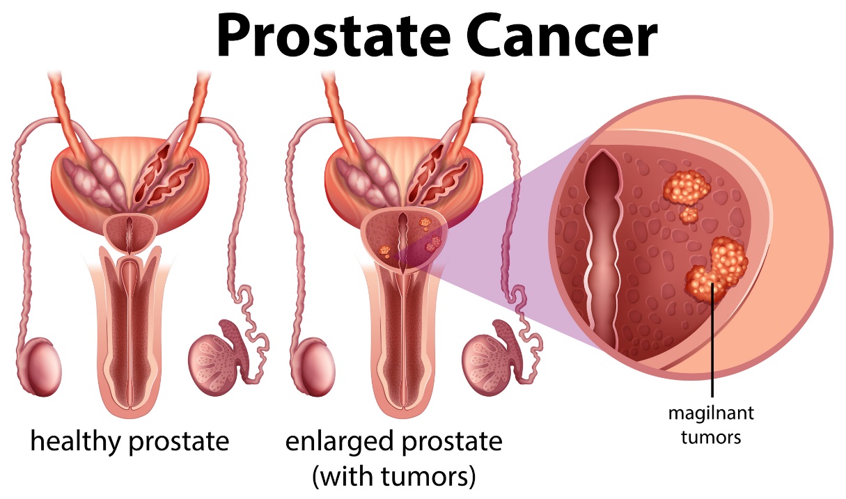 Prostatakrebs. Gesunde Prostata und vergrößerte Prostata mit Tumor.