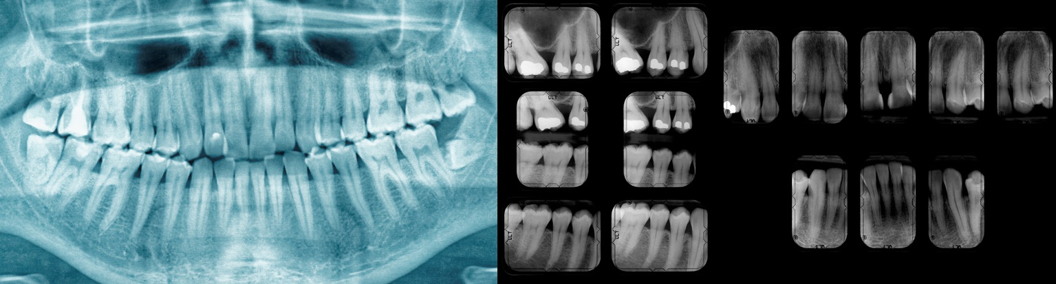 Zahnröntgen, das den Zustand der Zähne, Karies und Füllungen zeigt
