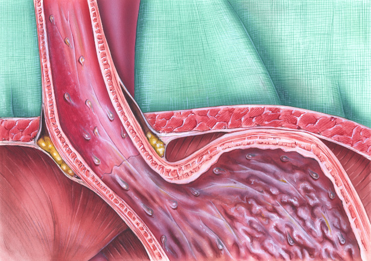anatomisch dargestellter Schließmuskel der Speiseröhre