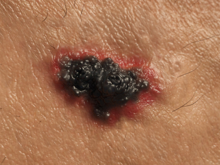 Hautkrebs, bösartiges schwarzes Melanom mit roten Rändern