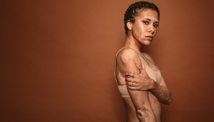 Frau mit weißen Flecken auf ihrem Körper - Vitiligo