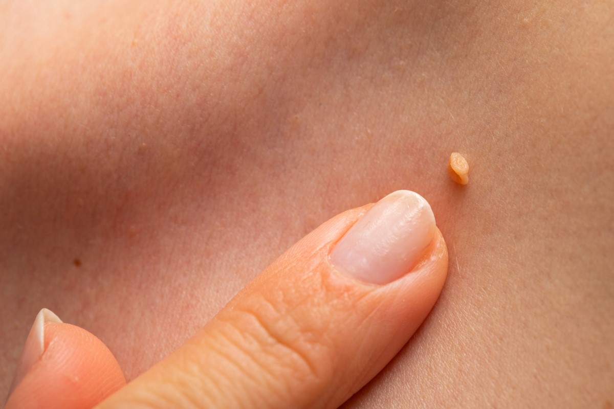 HPV-Warzen auf der Haut einer Frau