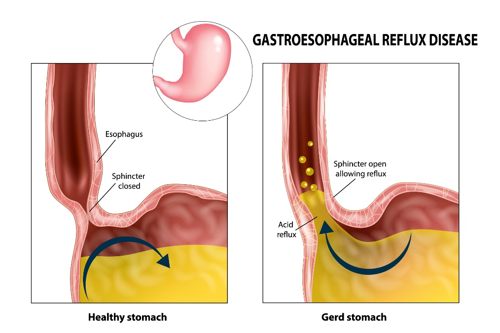 Gastroösophagealer Reflux: Speiseröhre, Schließmuskel, Magen und Magensäure