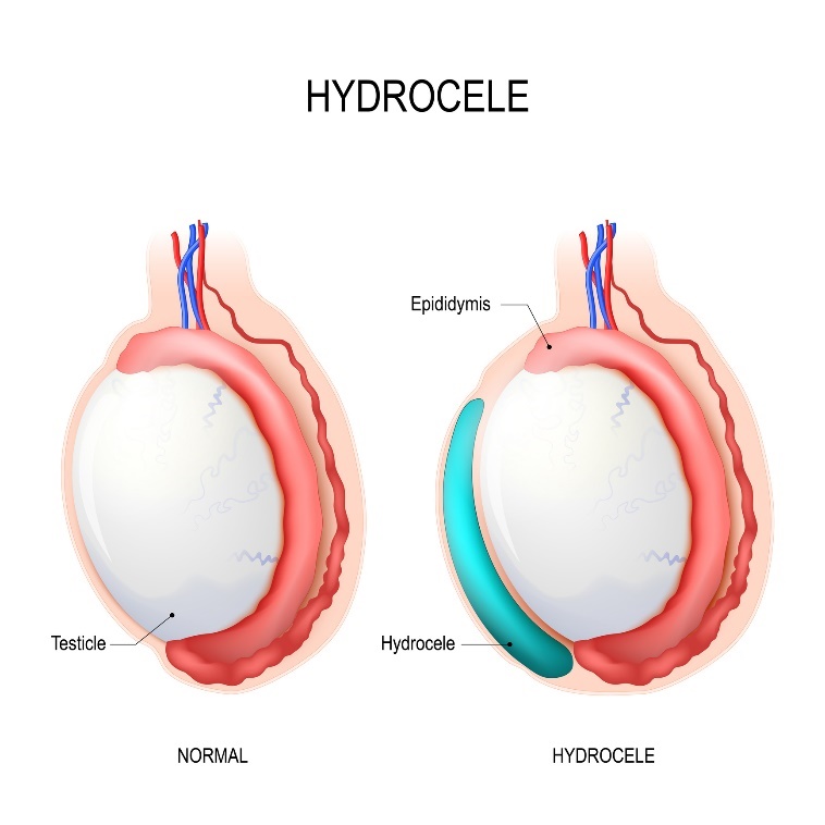 Hydrozele: Hoden, Nebenhoden, Hydrozele (Flüssigkeitsansammlung)