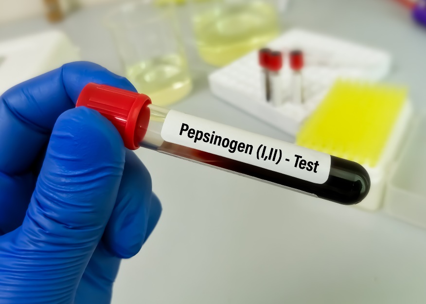 Blutprobe zur Laboruntersuchung des Pepsinogenspiegels und der Magen-Darm-Erkrankung