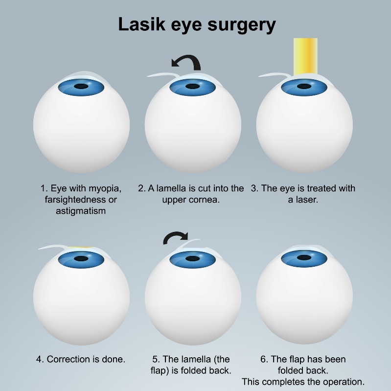 Augenlaserbehandlung LASIK - unterirdische Methode: Verfahren mit Flap/Lappen, ohne die Nervenenden zu beschädigen.