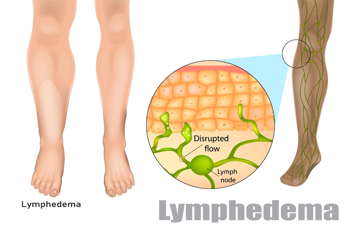 Lymphödem