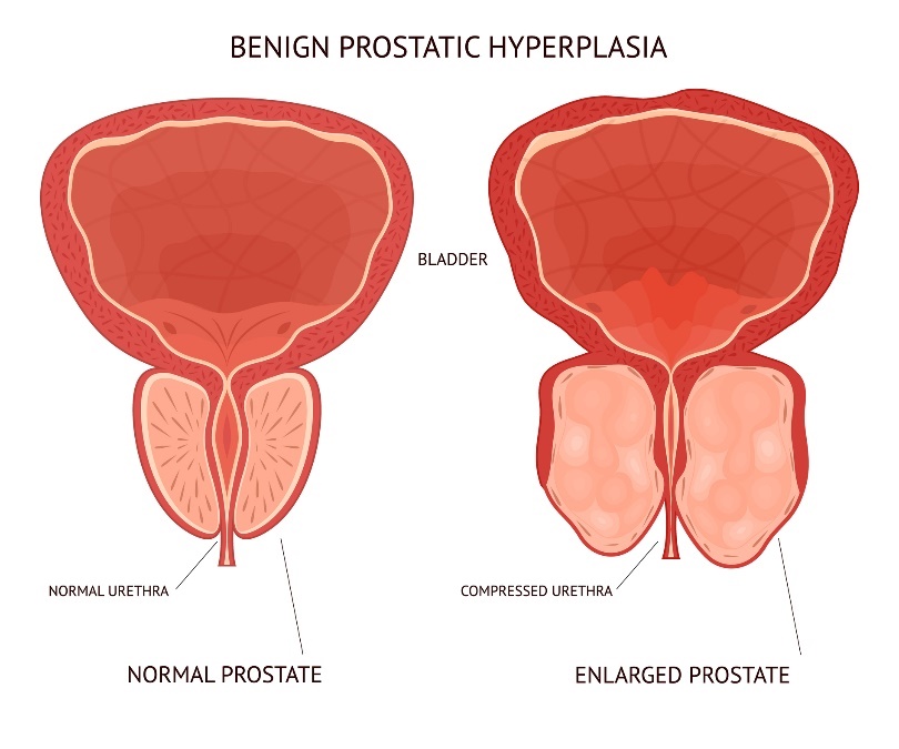 Gutartige (benigne) Vergrößerung der Prostata. Blase (Bladder), physiologisches und vergrößertes Gewebe des Organs Prostata.