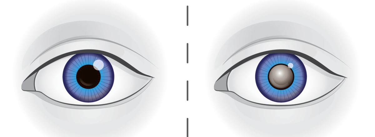Links: Ein Auge mit einer gesunden Linse. Rechts: Ein Auge mit einer getrübten Linse bei Katarakt.
