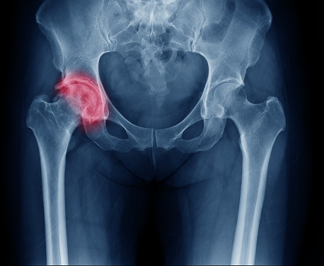 Röntgenaufnahme des Beckens, rechtes Hüftgelenk von Arthrose betroffen