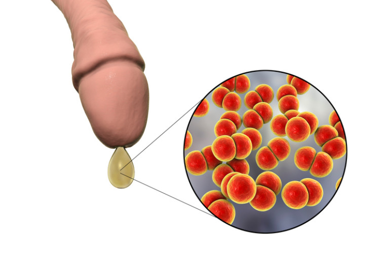 Penisödem mit Ausfluss und mikroskopischen Gonorrhoe-Bakterien