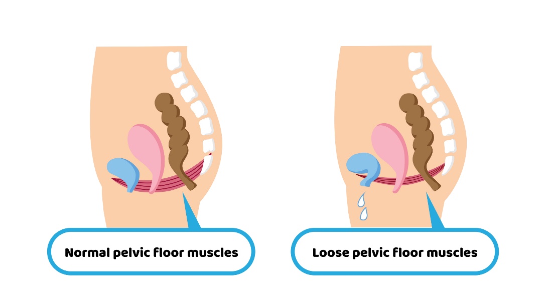 Physiologischer Zustand der Beckenbodenmuskulatur und permissiver Zustand der Beckenbodenmuskulatur, der zu Inkontinenz führt