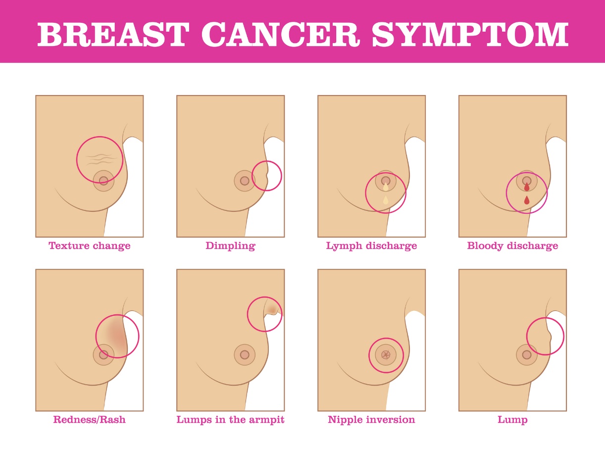 Symptome von Brustkrebs: Veränderung der Struktur der Brust, Veränderung der Farbe und der Oberfläche der Brust, Ausfluss und Einziehung der Brustwarze, Lokalisierung des Knotens.