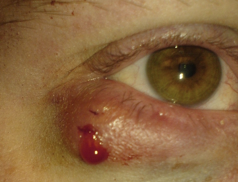 Chalazion, d.h. Hagelkorn, nach Einstich, zur Druckentlastung, durch Entzündung gequetschtes Augenlid, rechtes Auge.