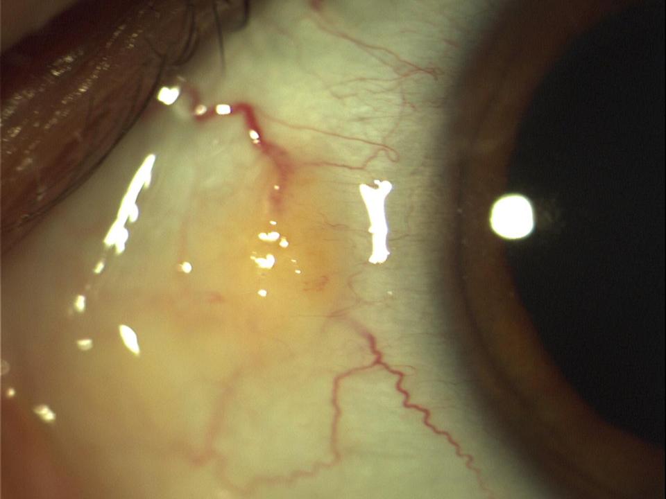 Auge mit Pinguecula-Krankheit