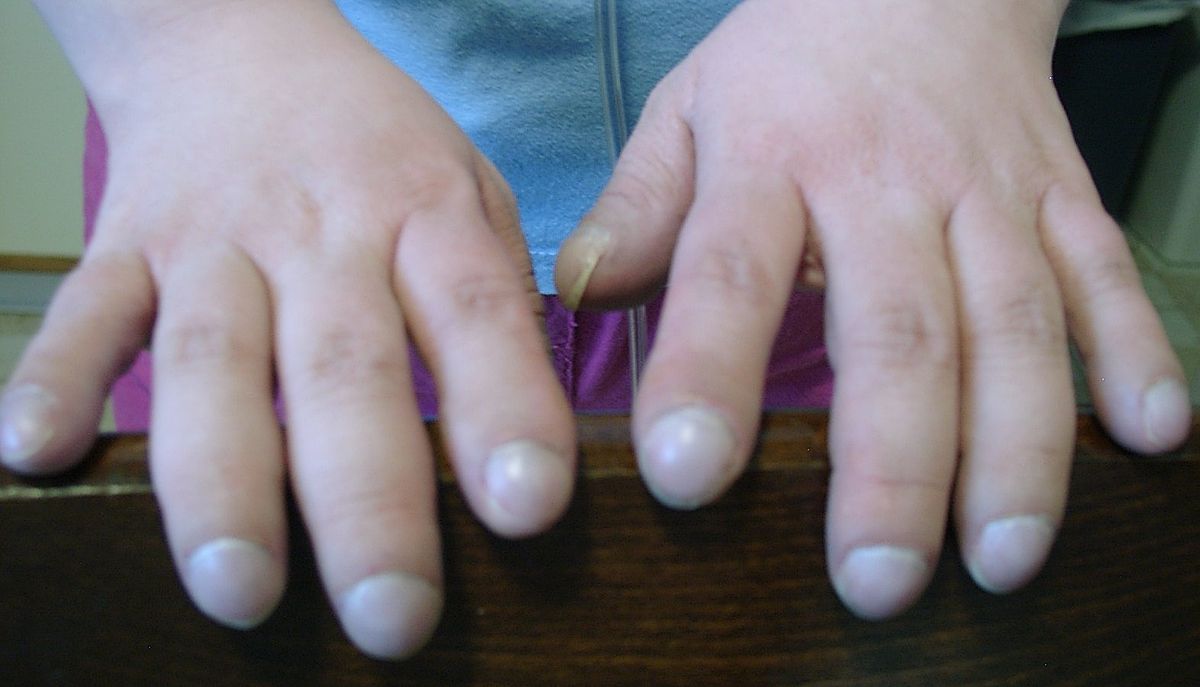 Stumpfe Finger als Symptom des Eisenmenger-Syndroms