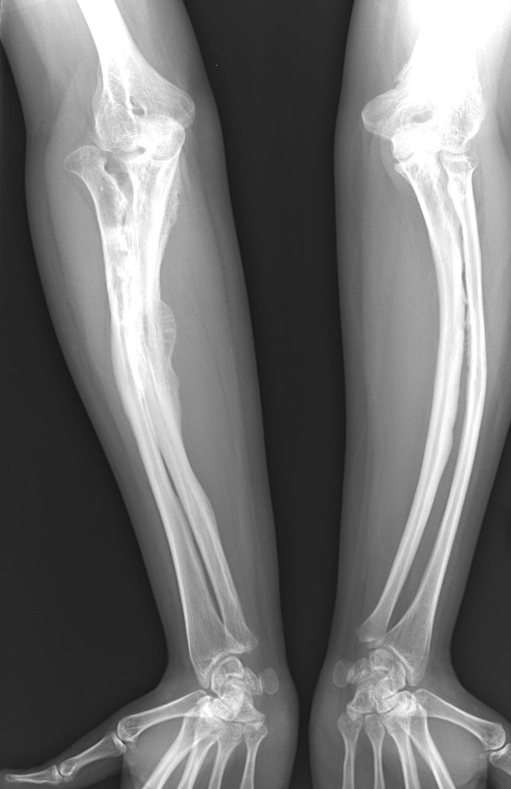 Röntgenbilder einer Osteogenesis imperfecta-Erkrankung bei einem Erwachsenen