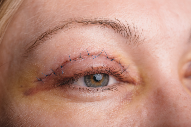 Frau, Gesicht und Augenlid nach Blepharoplastik - Blepharoplastik