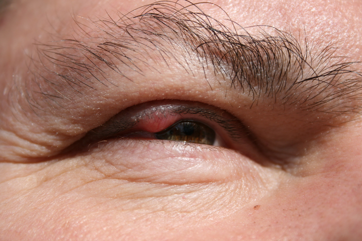 Ein Mann hat ein entzündetes Oberlid des rechten Auges, eine Entzündung der Talgdrüsen, ein Chalazion, d. h. Hagelkorn.