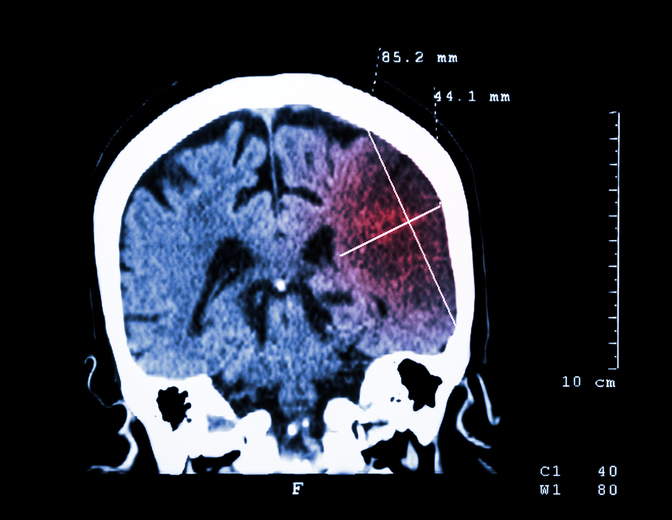 Hirnschädigung auf CT-Scan sichtbar