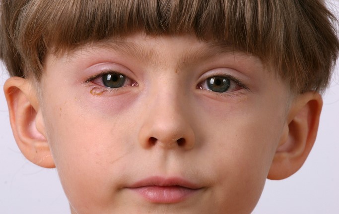 Das Kind hat ein entzündetes, rotes und geschwollenes Auge
