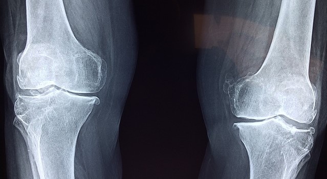 Röntgenaufnahme der Kniegelenke