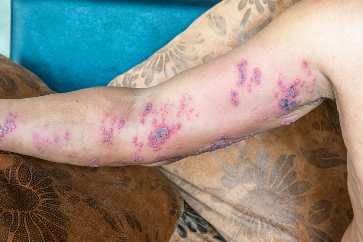 Hautinfektion an der rechten oberen Extremität bei Herpes Zoster, auch Nervenschmerzen in der Gegend