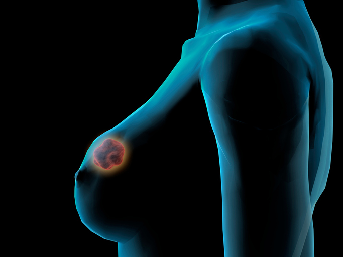Modell der weiblichen Brust, Brustkrebs