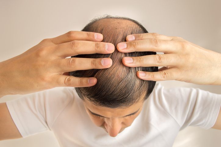 Mann mit spärlichem Haar, Haarausfall, Kahlheit oder Alopezie, Hände auf dem Kopf, Ansicht von oben