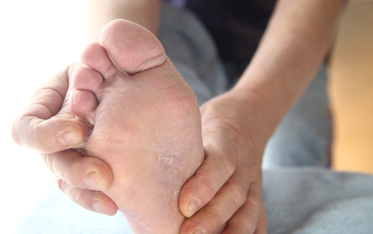 Fuß, Mykose, Schmerzen und Juckreiz der Haut