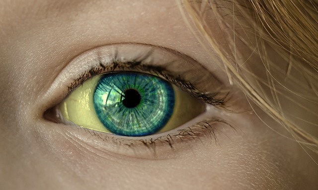 Gelbes Weiße des Auges bei Ikterus, Gelbsucht, Ausschnitt, Detail des Auges
