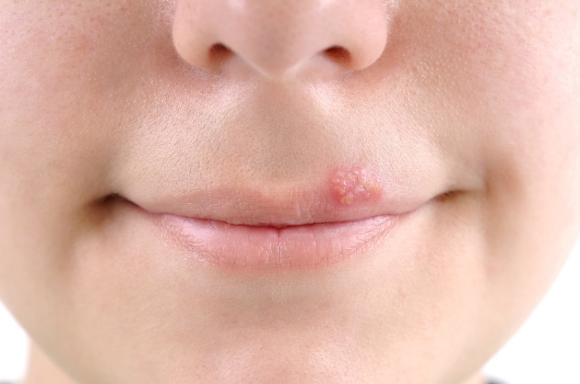 Bläschen - Fieberbläschen (Herpes) an der Mundschleimhaut.
