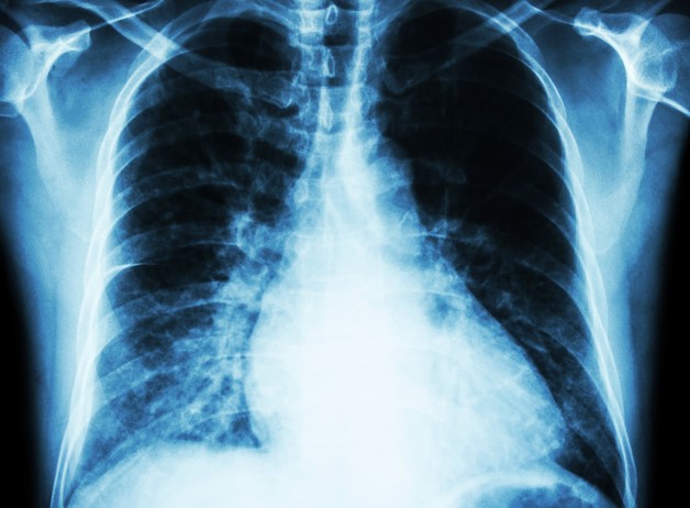 Röntgenbild Brustkorb, Herz - Vergrößerung