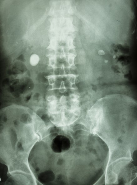 Röntgenaufnahme des Abdomens, Nierensteine auf beiden Seiten, in beiden Nieren